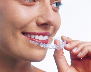 Invisalign1