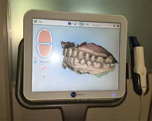 Invisalign_intraoralen_Scanner